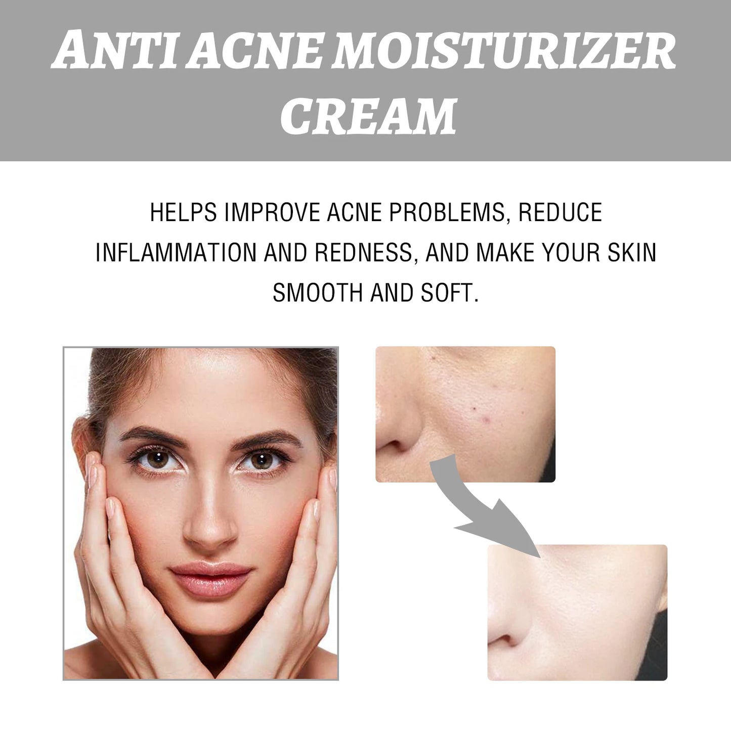 Whitening Anti Acne Cream Skin Care